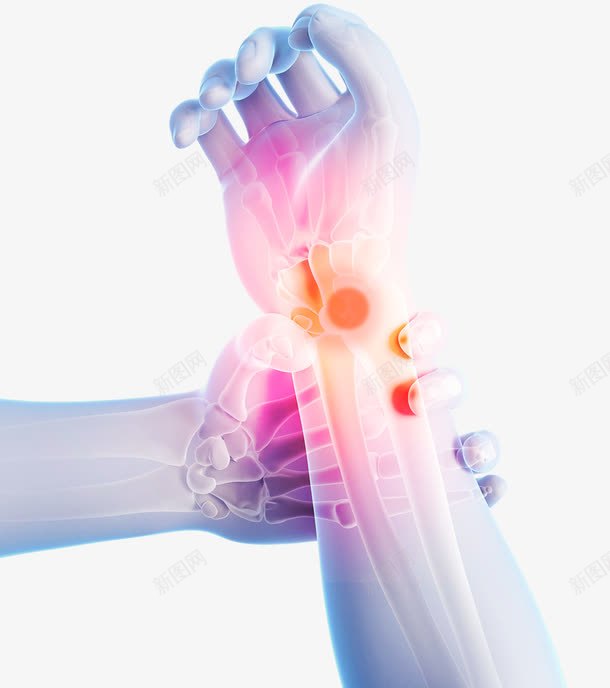 手腕关节炎效果图png免抠素材_新图网 https://ixintu.com 关节炎 手腕 效果图 透视 骨头