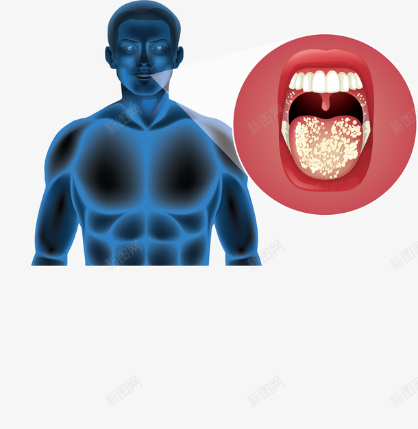 医疗卫生口腔疾病矢量图ai免抠素材_新图网 https://ixintu.com 医疗 医疗疾病 口腔 口腔溃疡 口腔疾病 矢量png 矢量图