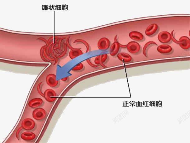 血红细胞示意图png免抠素材_新图网 https://ixintu.com 医学细胞 图示 手绘 红细胞 红细胞血液插图 血红细胞