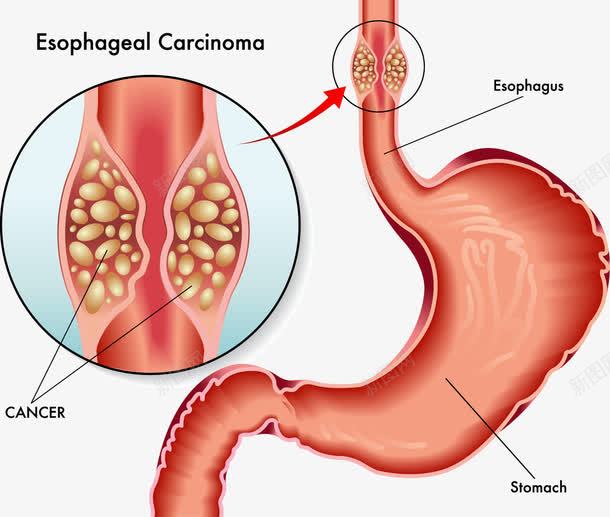 人体食管癌研究png免抠素材_新图网 https://ixintu.com 人体食管癌 医学研究 装饰