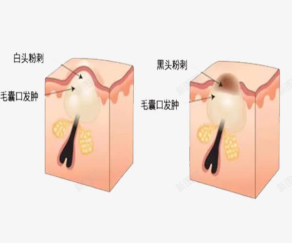 毛孔粗大png免抠素材_新图网 https://ixintu.com 发肿 毛囊 毛孔粗大 白头 黑头