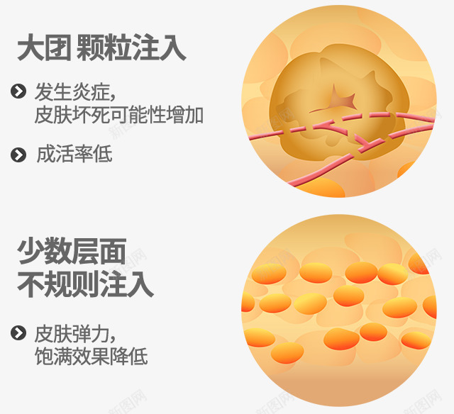 id脂肪移植纳米脂肪移植整体面部的自然饱满感塑造立png免抠素材_新图网 https://ixintu.com 脂肪 移植 纳米 整体 面部 自然 饱满 塑造