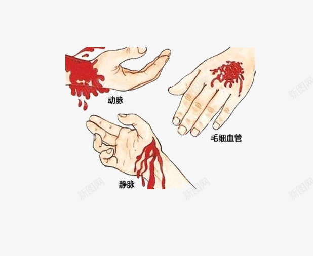 不同部位伤口png免抠素材_新图网 https://ixintu.com 严重 伤口 动脉 医学 喷血 喷血量 失血 教学 演示 过多