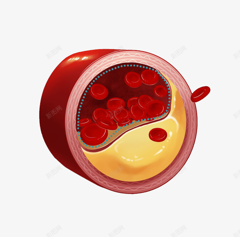 血管感染卡通插画png免抠素材_新图网 https://ixintu.com 医疗 器官 感染 横断面 疾病 红血球 血管感染卡通插画 身体部位