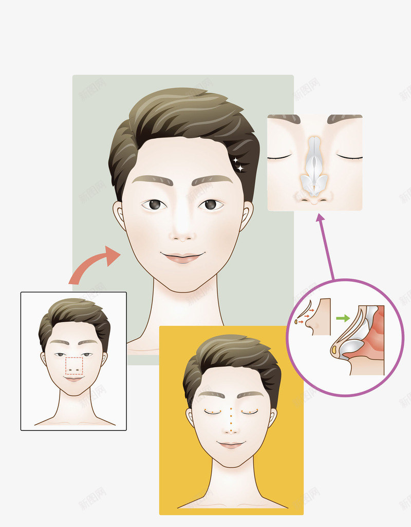 男士整形隆鼻手术png免抠素材_新图网 https://ixintu.com 假体 卡通 平面 微整 微调 整容整形 男士 隆鼻