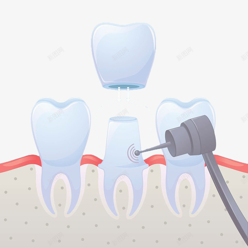 手绘护牙插图png免抠素材_新图网 https://ixintu.com 手绘 护牙 烤瓷牙 牙 白色