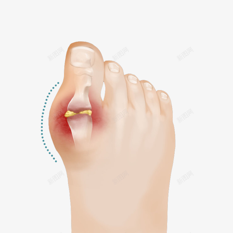 脚趾关节疾病插画png免抠素材_新图网 https://ixintu.com 免抠PNG 关节 医疗 器官 感染 横断面 疾病 脚 脚趾 脚趾关节疾病插画