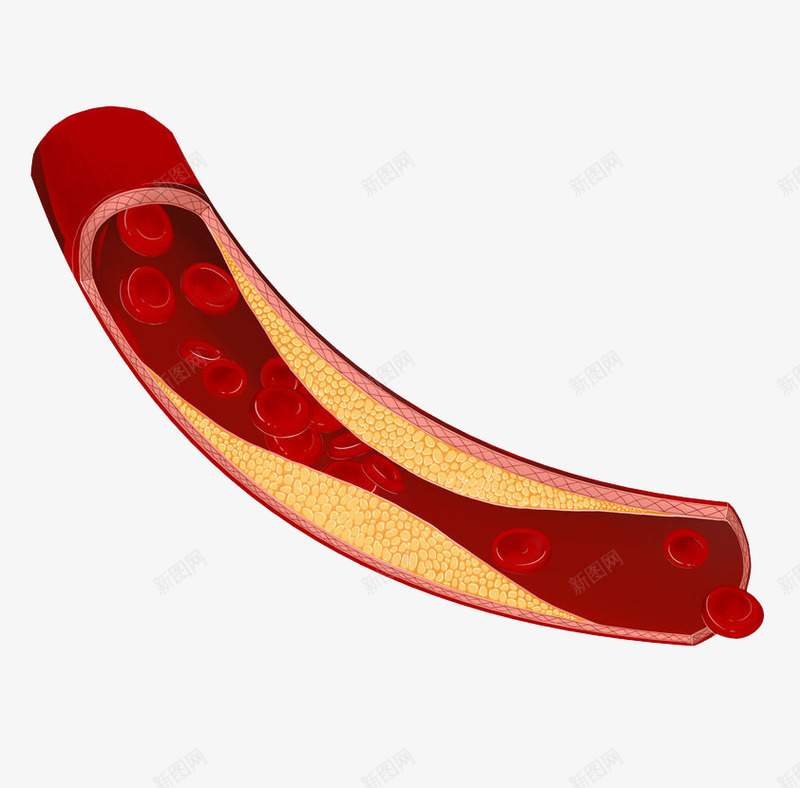血管疾病卡通插画png免抠素材_新图网 https://ixintu.com 免抠PNG 医疗 器官 胆固醇 血管疾病卡通插画 身体部位