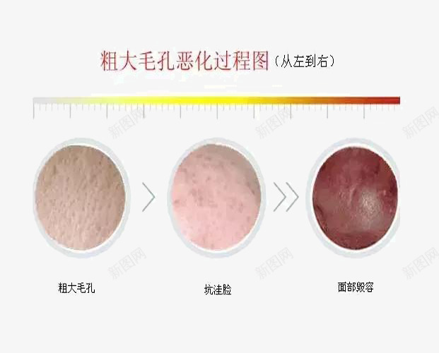 毛孔粗大png免抠素材_新图网 https://ixintu.com 对比 恶化 毛孔粗大 粗大 过程