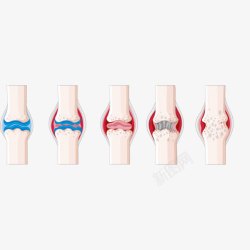 年轻骨质骨关节高清图片