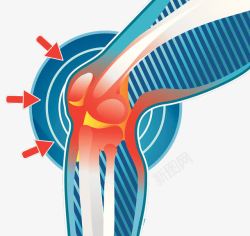 膝关节发炎插图素材