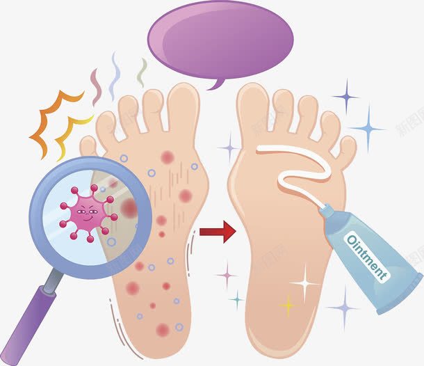脚气png免抠素材_新图网 https://ixintu.com 去脚气 双脚 左右脚 脚型 脚臭 足
