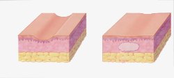 皮肤层细胞结构脂肪填充治凹陷疤痕高清图片
