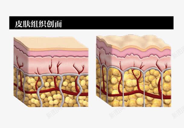 皮肤组织创面png免抠素材_新图网 https://ixintu.com 皮下组织 肌肤组织 解剖图