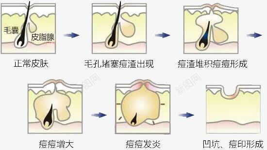 皮肤毛孔问题png免抠素材_新图网 https://ixintu.com 毛囊 皮肤组织结构 皮肤结构图 皮肤表皮 美容皮肤 肌肤组织