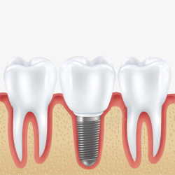 种牙种植的牙齿和正常的牙齿高清图片