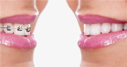 露牙齿的女人牙齿矫正高清图片