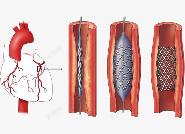 心脏解剖图png免抠素材_新图网 https://ixintu.com 动脉 堵塞 心脑疾病 心脑血管 血管