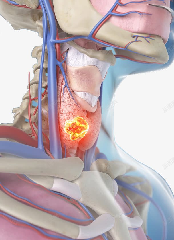 甲状腺结节疾病png免抠素材_新图网 https://ixintu.com 炎症 甲状腺 疾病 经脉 血液