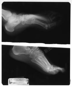 左脚X光透视图片左脚骨骼X光透视片高清图片