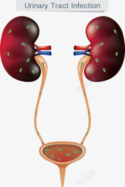 医学尿路感染示意图素材
