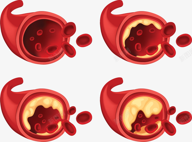 生物科学血管栓塞矢量图ai免抠素材_新图网 https://ixintu.com 人体血管 医疗科学 矢量png 血管 血管栓塞 血管病变 矢量图