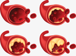 血管病变生物科学血管栓塞矢量图高清图片