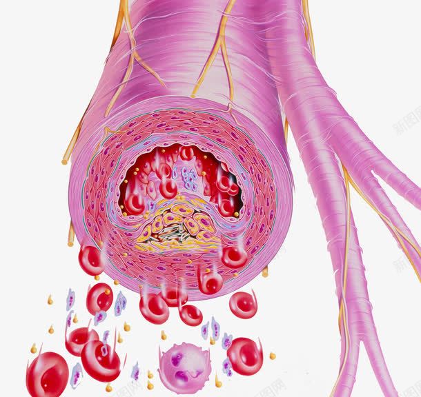 胆固醇血管异常png免抠素材_新图网 https://ixintu.com 医疗插图 胆固醇 脂肪 血管 血脂