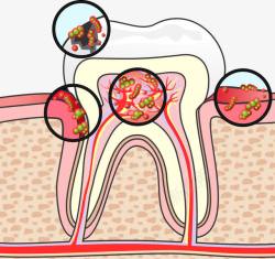 病菌牙齿矢量图素材