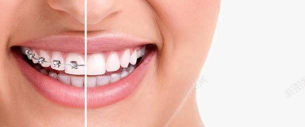 带牙套的美女png免抠素材_新图网 https://ixintu.com 健康牙齿 带牙套的美女 牙套 牙科 牙齿 牙齿美白 矫正洁白