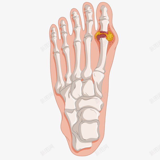手绘卡通骨折示意图矢量图ai免抠素材_新图网 https://ixintu.com 医学 医疗 左脚 脚 脚部 骨头 骨折 骨骼 矢量图
