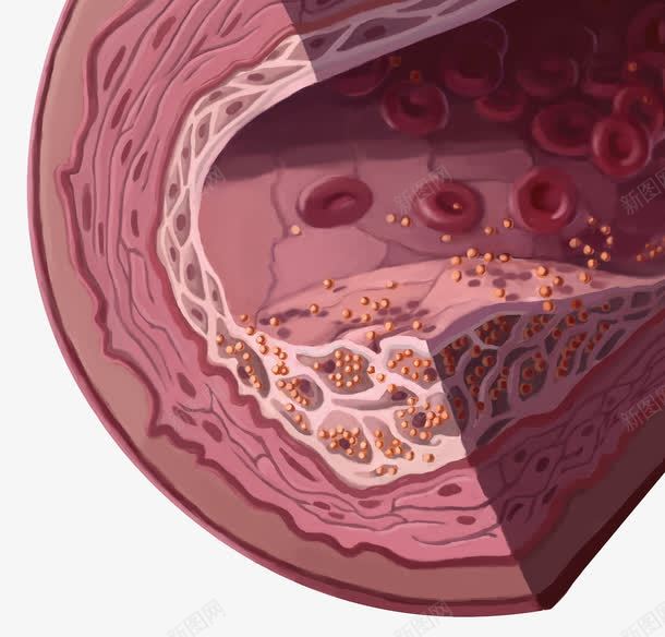 血管动脉硬化png免抠素材_新图网 https://ixintu.com 胆固醇 血小板 血管硬化 血脂细胞