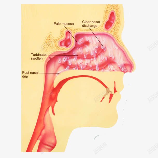 鼻炎形成示意图png免抠素材_新图网 https://ixintu.com 医院 挂图 解剖图 鼻炎