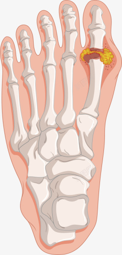 人体足部骨质增生矢量图素材