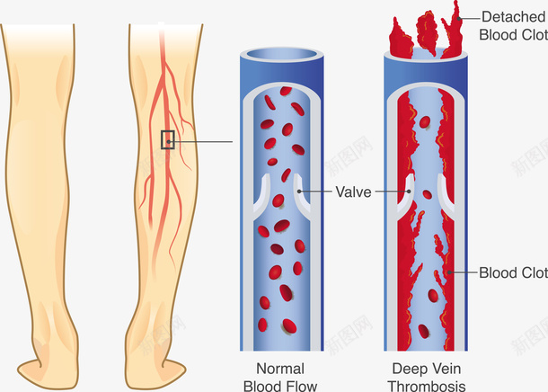 血管堵塞矢量图eps免抠素材_新图网 https://ixintu.com 堵塞PNG 小腿 小腿血管 矢量堵塞 血管PNG 血管堵塞 矢量图