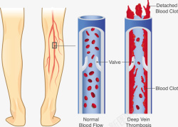 小腿血管血管堵塞矢量图高清图片