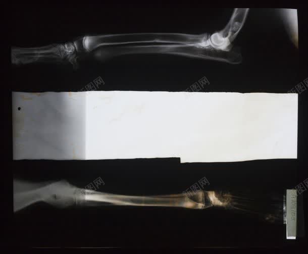 两个骨骼X光对比效果jpg设计背景_新图网 https://ixintu.com X透视 两个骨骼X光对比效果图片 两个骨骼X光对比效果图片素材下载 其它类别 医疗 图片素材 拍X光线 肢体骨骼 背景花边 骨科 骨骼对照
