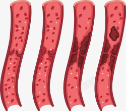 人类血管人类血管栓塞变化矢量图高清图片