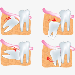 医学图示卡通四种智齿生长方向图示插画免高清图片