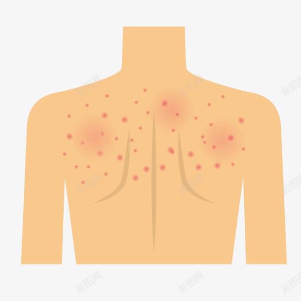 卡通背部痤疮png免抠素材_新图网 https://ixintu.com 医院图示 卡通痤疮 皮肤表皮 皮肤过敏 皮肤问题 背部痤疮