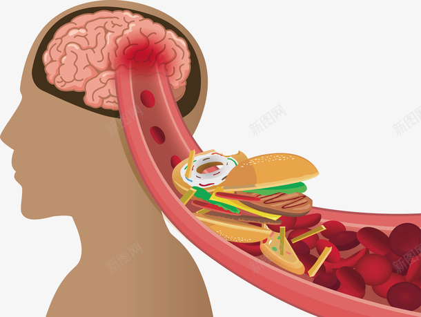大脑血管堵塞矢量图eps免抠素材_新图网 https://ixintu.com 垃圾 垃圾PNG 垃圾下载 大脑 大脑垃圾 矢量垃圾 血管堵塞 矢量图