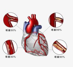 血管堵塞心脏疾病高清图片