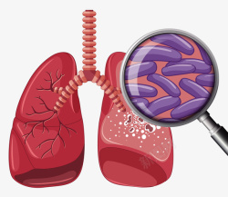 肺病肺病与病菌矢量图高清图片