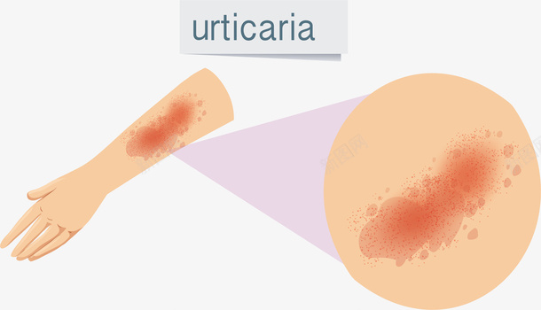 皮肤病荨麻疹放大图png免抠素材_新图网 https://ixintu.com 医疗 皮肤 皮肤病 皮肤表皮 矢量png 荨麻疹 风团