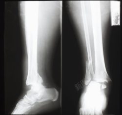 人物腿部腿部x光片摄影高清图片