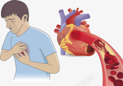 矢量堵塞心脏血管堵塞矢量图高清图片