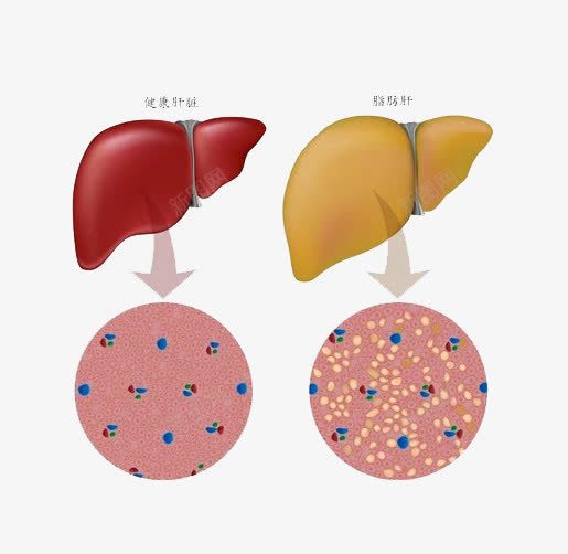 正常肝脏和脂肪肝对比图png免抠素材_新图网 https://ixintu.com 对比图 正常肝脏 脂肪肝 酒精肝