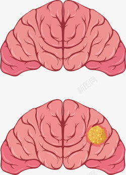 人类大脑疾病对比矢量图素材