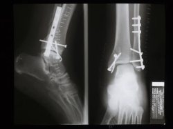 人体小腿打钢板的小腿和脚x光图像高清图片