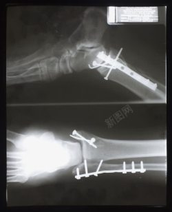 骨骼检查打钢钉和钢板的小腿x光图像高清图片